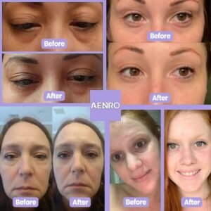 NewEye™Pro | Eyebag Removal Device (🔥Hot Sale 59% OFF) - Emporium Shop